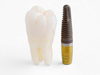 implant